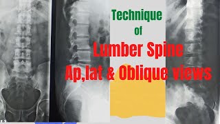 Technique of L Spine Ap  Lat amp Oblique views Ep63 Xray lumber spine views [upl. by Branden]