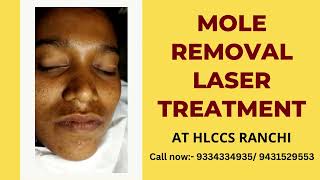 Mole Removal Laser Treatment at Hlccs RanchiCall now 9334334935 moleremoval hlccsranchi [upl. by Atikan]