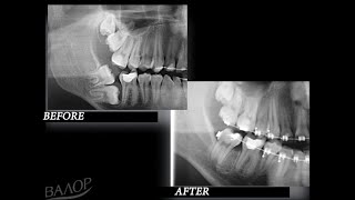 HOW BRACES WORK timelapse of Amazing uprighting of Impacted second and third molars [upl. by Lessur]