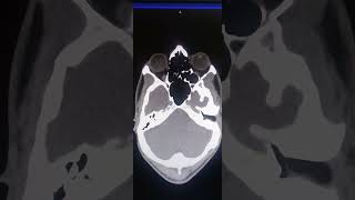 acute otitis externa [upl. by Nairad559]