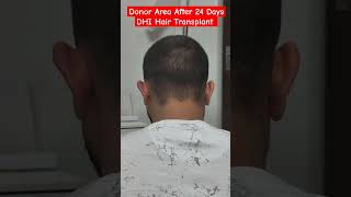 Donor Area After Day 24  DHI Hair Transplant besthairtransplant dhivsfue [upl. by Skardol]