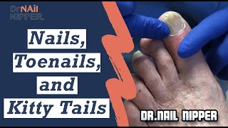 What is Paronychia Nails Toenails and Kitty Tails [upl. by Weide]