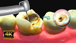 Caries GIGANTE con HONGOS en 4k  Tratamiento de conducto [upl. by Allimrac904]