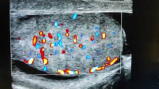 acute epididymoorchitis Tauhid ultrasonography Cumilla [upl. by Dnana]