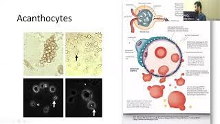 APPROACH TO NEPHRITIC AND NEPHROTIC SYNDROMES  DR JAYAPRAKASH THANGAVEL NEPHROLOGY [upl. by Cudlip]