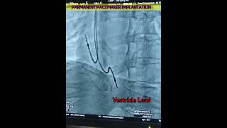 Permanent pacemaker implantation is a surgical procedure  🫀 [upl. by Klatt]