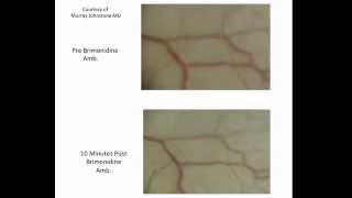 Video Brimonidine Causes Rapid Increase in Pulsatile Aqueous Outflow [upl. by Arnuad176]