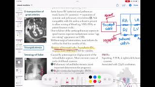 Tricuspid Atresia congenitalheartdisease cardiology 55 First Aid USMLE Step 1 in UrduHindi [upl. by Lleda]