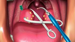 Animation Surgery of Tonsillectomy amp Adenoids [upl. by Greenlee846]