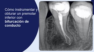 Cómo instrumentar y obturar un premolar inferior con bifurcación del conducto [upl. by Htrahddis]