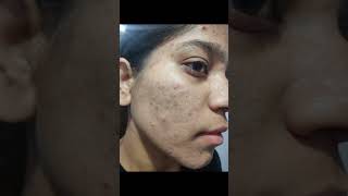 2 month complete tretinoin cream 0025 face tretinoin skincare tretinoincream darkspots face [upl. by Marden810]