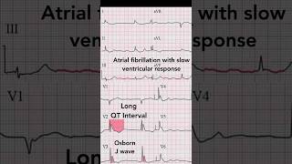 Hypothermia ECG [upl. by Jolee295]