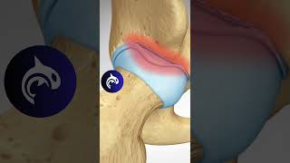 See what a Labral Tear of the Hip looks like in 3D animation [upl. by Ayerhs]