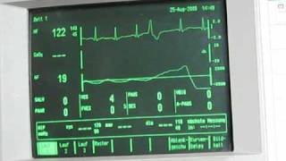 cardiac arrhythmia EKG [upl. by Sofer]