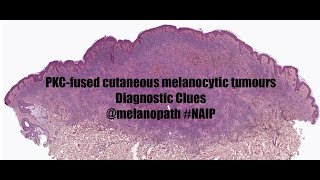 Clues to the diagnosis of PKCfused cutaneous melanocytic tumours NAIP project [upl. by Hirst374]