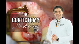 Corticotomy of impacted canine in orthodontics [upl. by Schroth]