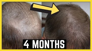 4 Months after my 2nd FUE Hair Transplant Matt Dominance [upl. by Drarrej]