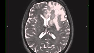 Grade 3 Anaplastic Astrocytoma [upl. by Leatri]