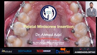 𝗢𝗿𝘁𝗵𝗼 𝗺𝘆 𝗪𝗮𝘆 …𝘁𝗼… Palatal Miniscrew TADs [upl. by Airtened]