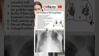 Chest X Ray of Lung Edema medical doctor nursing [upl. by Aicital]