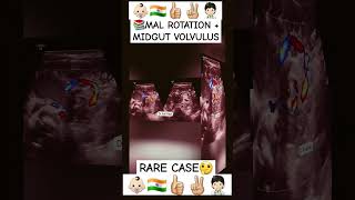 🧑🏻‍⚕️👶🏻📚MAL ROTATION  MIDGUT VOLVULUS✌🏼👍🏻🇮🇳  by DIVINE PAEDIATRICS CRITICAL CARE TEAM AHMEDABAD [upl. by Eduam206]