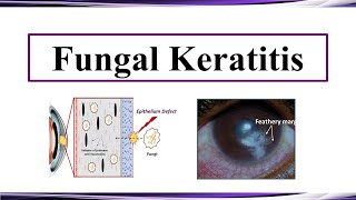 Fungal Keratitis [upl. by Einnor]