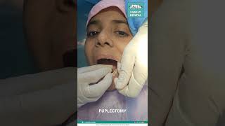 Pulpectomy FamilyDentalMoulali [upl. by Niamreg]