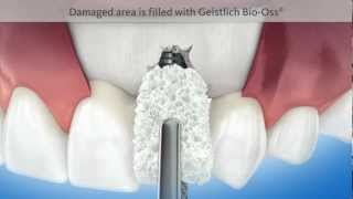 Dental animation Bone formation around a dental implant GEISTLICH  3D Animation Medizin [upl. by Adrea407]