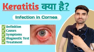 Keratitis Lecture in Hindi  Causes Symptoms and Treatment of Keratitis [upl. by Arita]