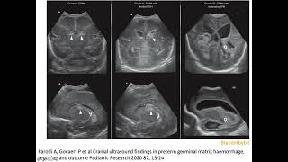 14 Intraventricular hemorrhage germinal matrix IVH caudothalamic premature NICU neuroimaging [upl. by Amerd]