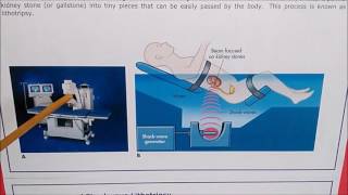 Lithotripsy  Ellipse in medical application [upl. by Madeleine]