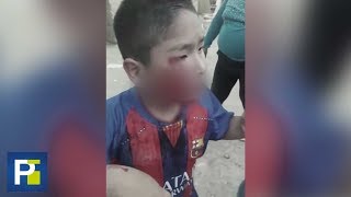 Con el rostro destrozado así acabó un niño tras el ataque de un perro en Perú [upl. by Cherise296]