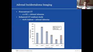 Pheochromocytoma and the Adrenal Incidentaloma [upl. by Barbaresi]