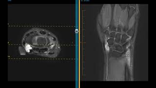 Lump in radial wrist Rule out ganglion cyst [upl. by Nyrhtakyram356]