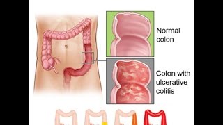 Ulcerative Colitis [upl. by Atteuqahs]