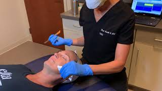 Applying EMLA Numbing Cream at Home  Before Your Microneedling Appointment [upl. by Anhsirk216]