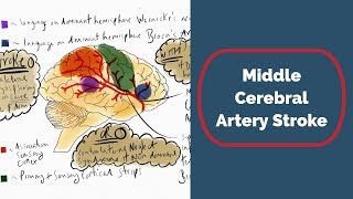 Middle Cerebral Artery Stroke [upl. by Iman9]