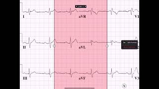 PWAVE PRI MEASUREMENTS [upl. by Davida]