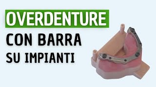 BARRA su Impianti dentali per OVERDENTURE [upl. by Neral]