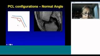 Radiologists View on Posterior Cruciate Ligament by Dr Anna Chacko [upl. by Maillil856]