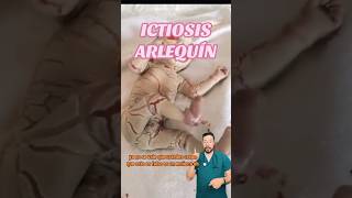 ICTIOSIS ARLEQUÍN  Es real  ¿Tiene cura ¿Se puede vivir con esta enfermedad internista doctor [upl. by Enahc]