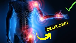 Celecoxib vs Other NSAIDs Which Is Better for Arthritis Pain Relief [upl. by Asabi]