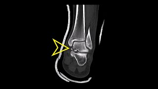 Ankle CT Talus Neck Fracture [upl. by Ameyn]