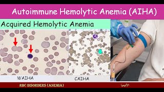 Lecture 295 Auto Immune Hemolytic Anemia AIHA [upl. by Smaoht]