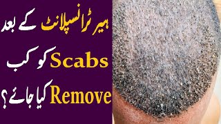 Remove scabs after hair transplant  Hair transplant  dr Zunair Munir [upl. by Yramesor]