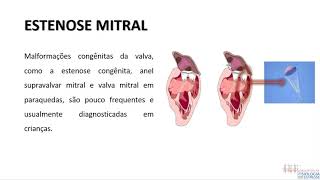 ESTENOSE E INSUFICIÊNCIA MITRAL [upl. by Lleirbag]