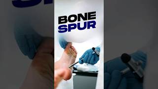 How Arthritis Leads to Cartilage Wear Bone Spurs and Joint Calcification [upl. by Azaleah]