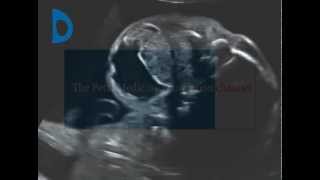 Fetal Medicine Foundation  neck teratoma [upl. by Nivrad]