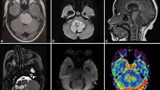 Posterior fossa mass causing moderate hydrocephalus  Medulloblastoma fits  Papilledema [upl. by Uranie]