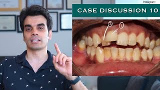 Case Discussion 10  Fixing the MalalignmentCrowding [upl. by Melloney]